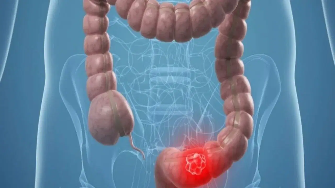 Islenmis gida ve sigara kolorektal kanseri tetikliyor EHXVSQu1.jpg