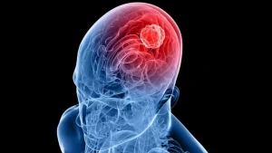 Burun spreyiyle ölümcül beyin tümörü tedavisi