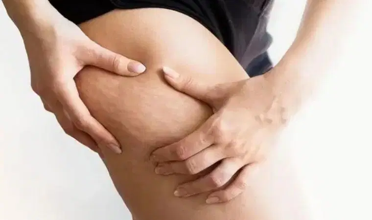 Selülit mi, lipödem mi? selulit-mi-lipodem-mi-eE1NfM7u.jpg